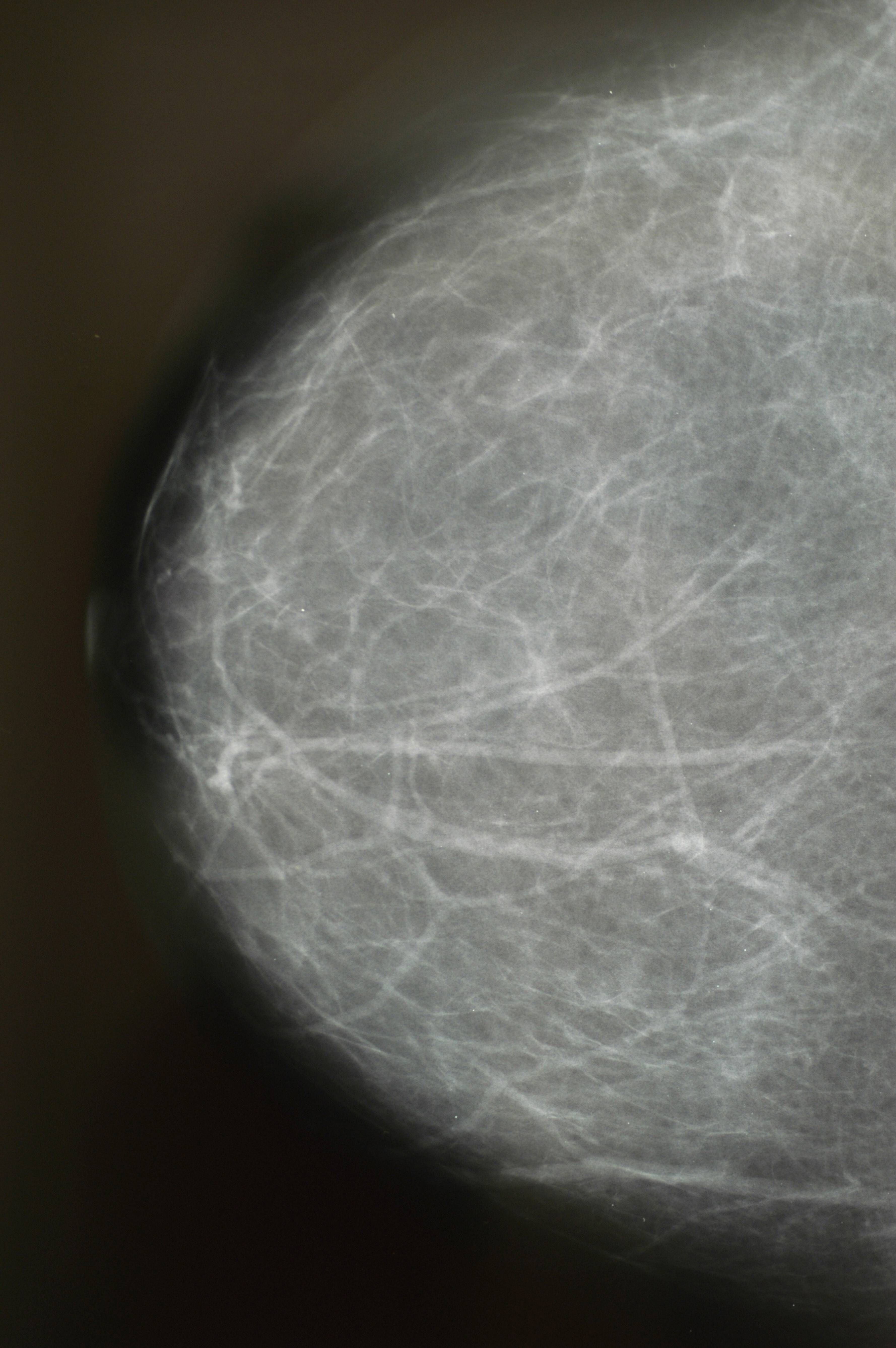 Roentgenaufnahme, Brustroentgen Mammographie einer Frau