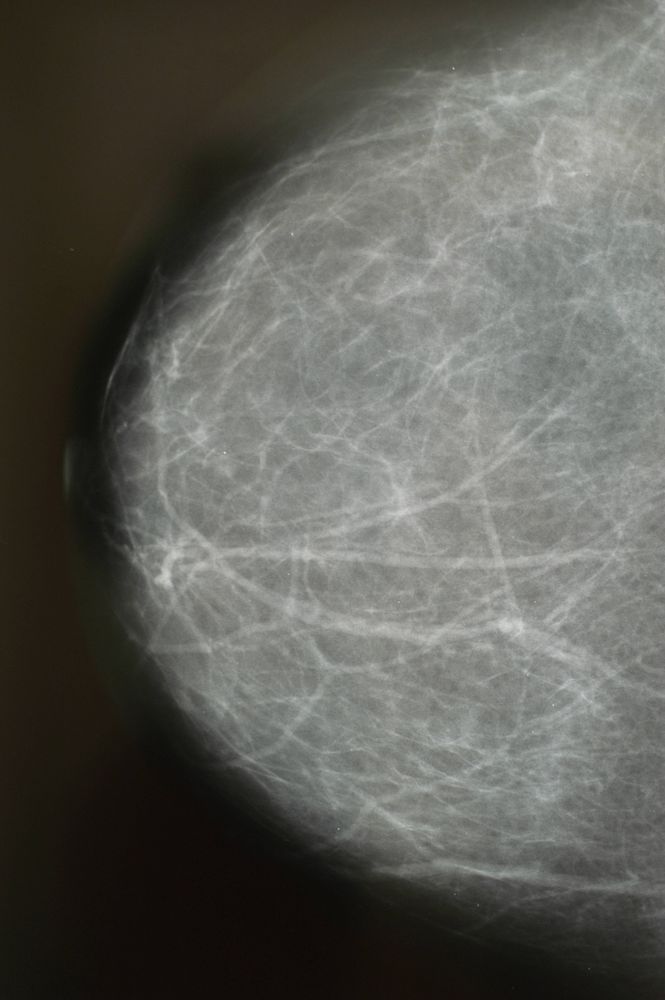 Roentgenaufnahme, Brustroentgen Mammographie einer Frau