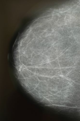 Roentgenaufnahme, Brustroentgen Mammographie einer Frau